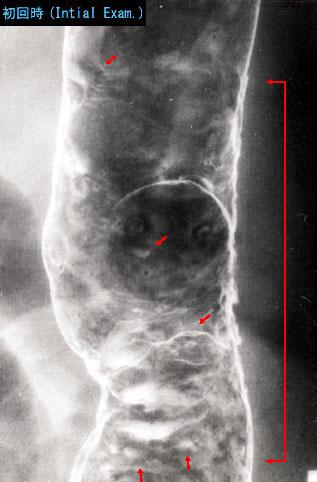 病变 克罗恩(crohn)病(肠)   内窥镜可见有明显的鹅卵石路特征外观