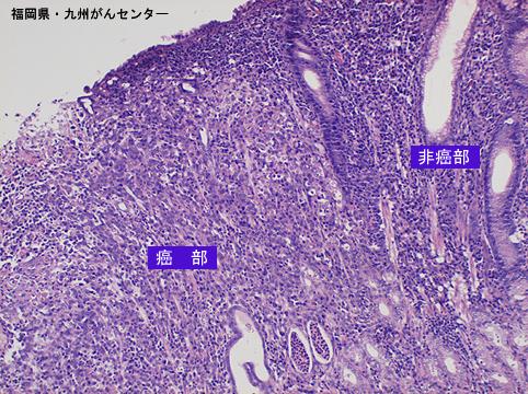 从疾病清单中查看病例 消化道的早期癌 早期胃癌 早期胃癌iic型(iic)